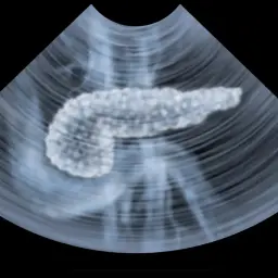 Ultraschallbild einer Bauchspeicheldrüse. Die Pankreas Untersuchung zeigt das Organ in detaillierter Ansicht.