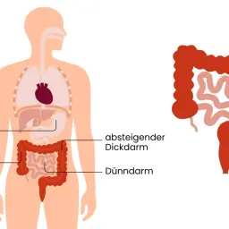 Illustration zeigt den menschlichen Verdauungstrakt mit einem hervorgehobenen Bereich, der Darmkrebs und Geschwüre im Dickdarm darstellt. Frühzeitige Erkennung von Darmkrebs Symptomen ist wichtig.