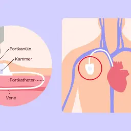 Schema zeigt ein medizinisches Portsystem: eine Nadel (Portkanüle) in der Kammer, verbunden mit einem Katheter in einer Vene. Das Port-System liegt nahe dem Herzen.