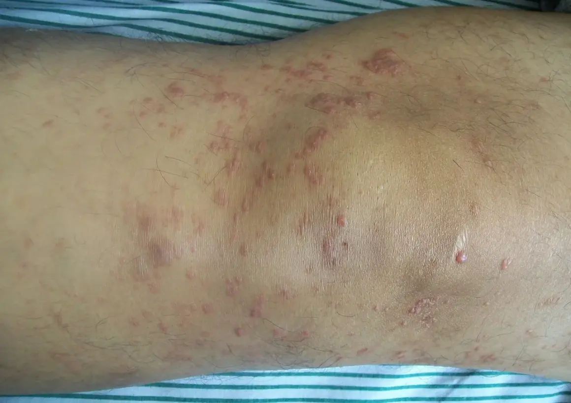 Hautveränderungen, die auf Mycosis fungoides hindeuten, zeigen sich als rote, schuppige Flecken und Plaques am Bein.