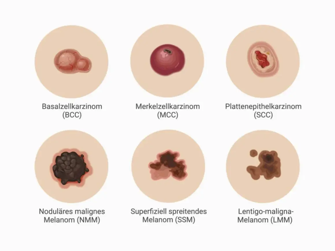 Sechs Hautveränderungen: Basalzellkarzinom, Merkelzellkarzinom, Plattenepithelkarzinom, noduläres malignes Melanom, superfiziell spreitendes Melanom und Lentigo-maligna-Melanom. Diese zeigen verschiedene Formen von Hautkrebs, darunter auch schwarzer Ha...