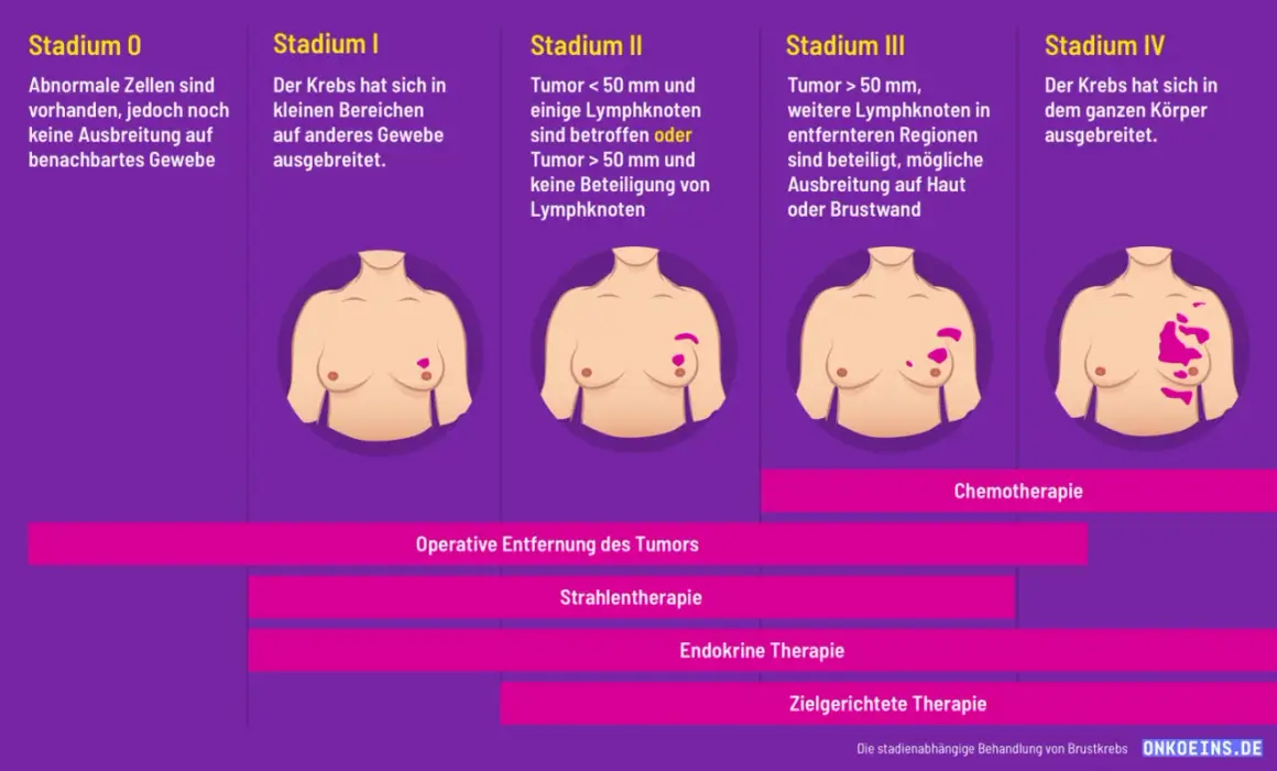 Brustkrebsstadien von 0 bis IV. Bei fortgeschrittenem aggressiver brustkrebs ist Chemotherapie eine Option.