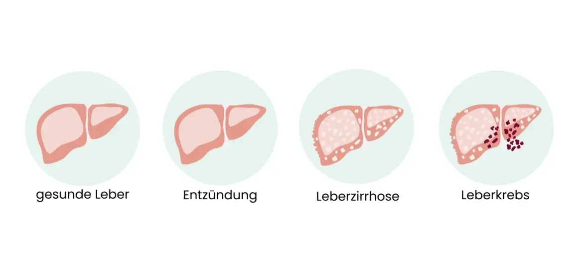 Illustration zeigt gesunde Leber, Entzündung, Leberzirrhose und Leberkrebs. Frühe Anzeichen von Leberkrebs sind oft unspezifisch.