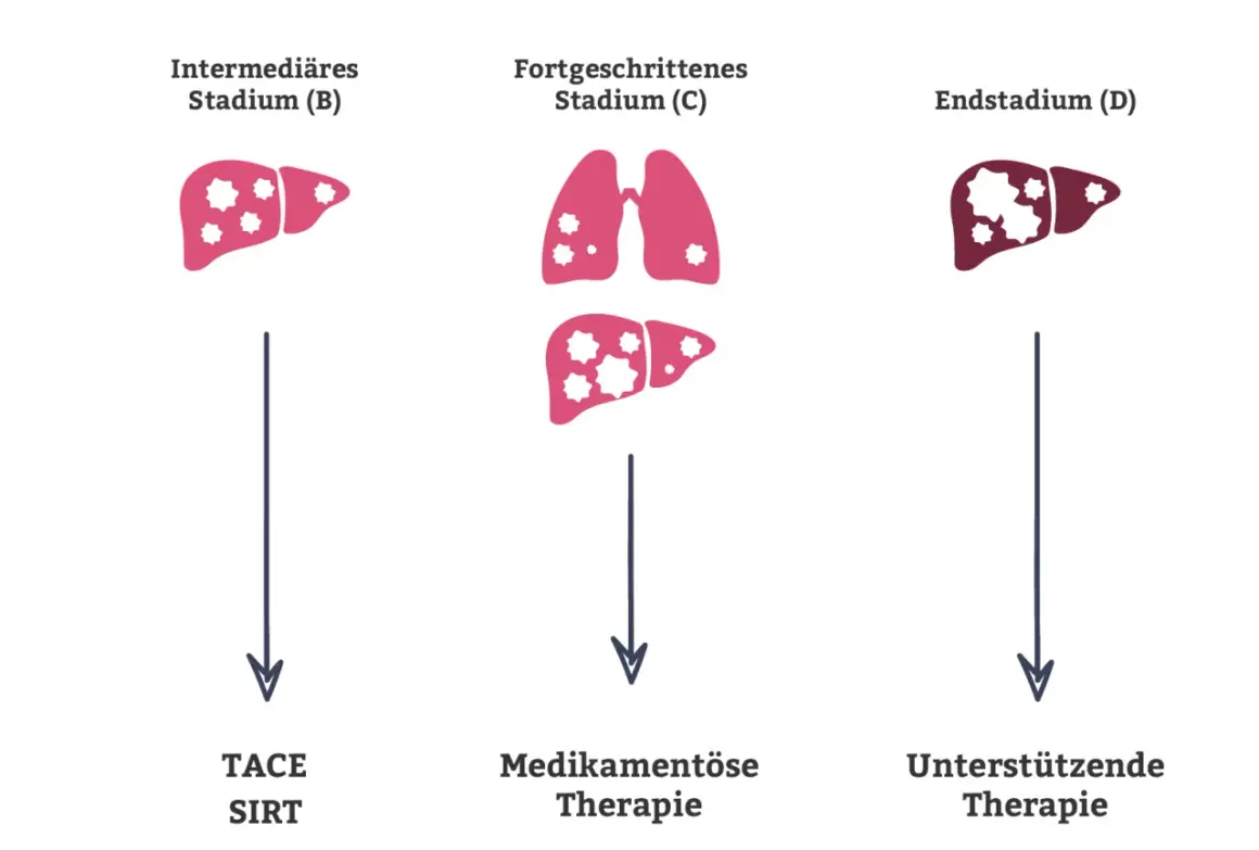 Illustration zeigt Leberstadien mit zunehmenden Metastasen. Stadium B: Leber mit wenigen Metastasen, Therapie TACE/SIRT. Stadium C: Lunge und Leber mit Metastasen, medikamentöse Therapie. Stadium D: Leber mit vielen Metastasen, unterstützende Therapie.
