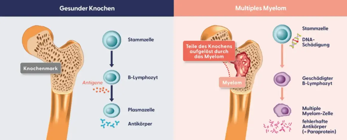 Erster Schritt der Therapie: gesunder Knochen vs. multiples Myelom. Myelomzellen schädigen Knochen und produzieren fehlerhafte Antikörper.