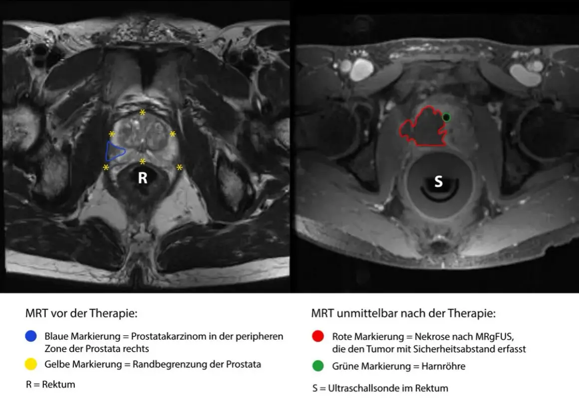 MRT-Aufnahmen zeigen metastasierten Prostatakrebs vor und nach Therapie. Links: Prostatakarzinom (blau) und Prostata-Rand (gelb). Rechts: Nekrose (rot) nach MRgFUS.