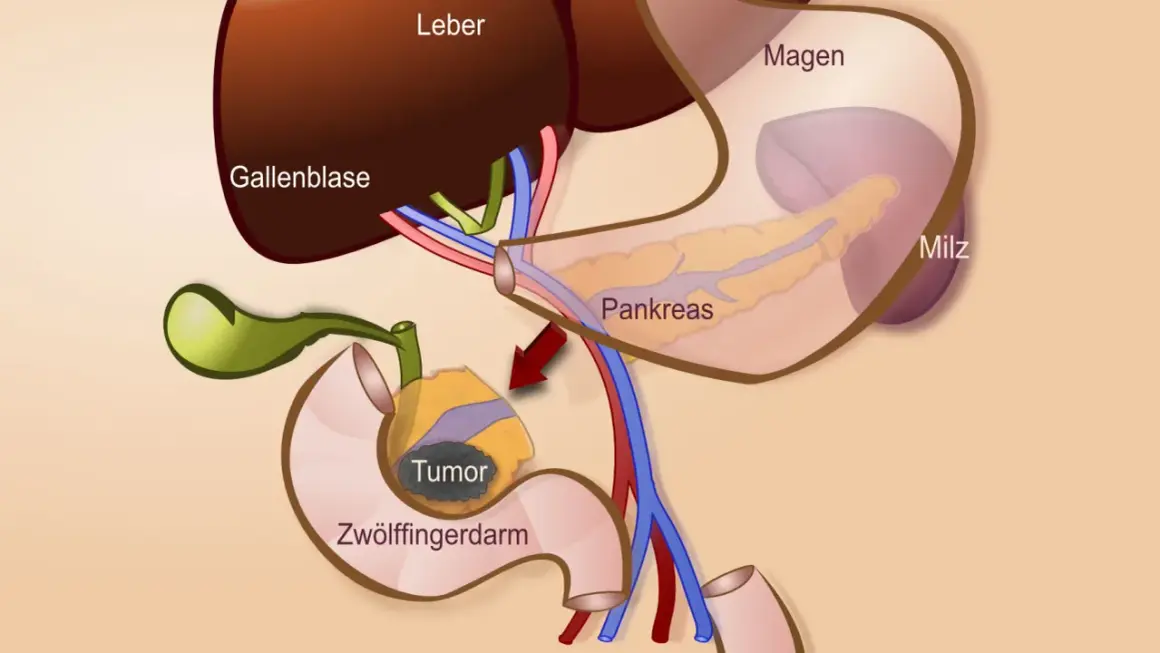 Anatomische Darstellung des Pankreas, Zwölffingerdarms und der Gallenblase mit einem Tumor. Zeigt den Bereich für eine partielle duodenopankreatektomie.