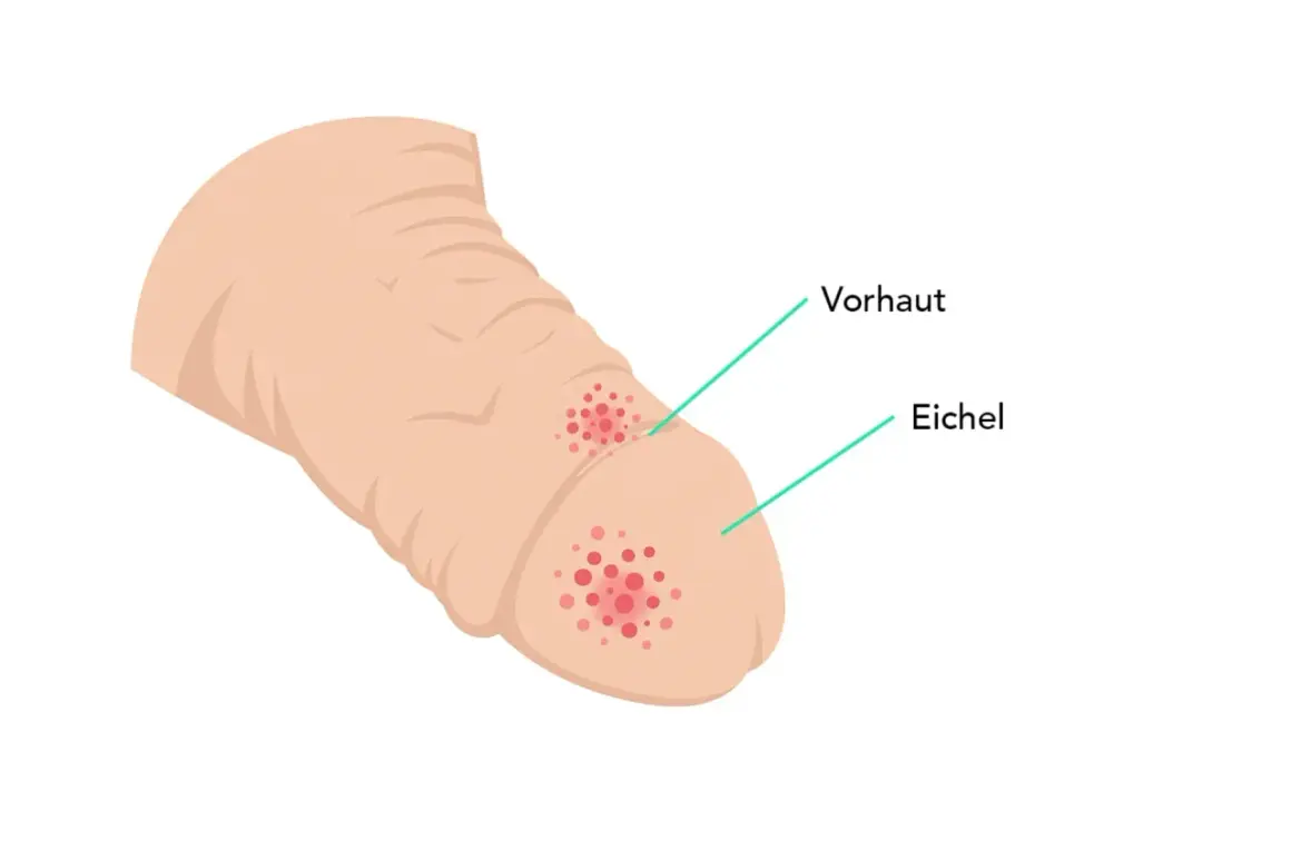 Illustration zeigt rote Flecken auf Vorhaut und Eichel, die auf mögliche peniskarzinom bilder hinweisen könnten.