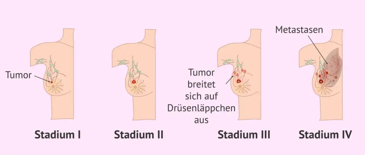 Illustrationen zeigen Stadien von Brustkrebs. Von Stadium I bis IV wächst der Tumor, befällt Lymphknoten und bildet Metastasen. Brustkrebs G3 Erfahrungen sind oft mit fortgeschrittenen Stadien verbunden.