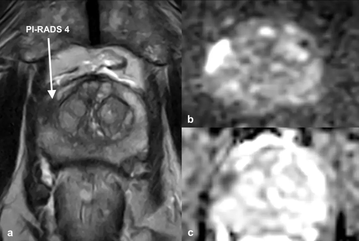 MRT Prostata Befund verstehen: Bild a zeigt eine Läsion mit PI-RADS 4. Bilder b und c zeigen die Diffusionsbildgebung, die bei der Interpretation hilft.
