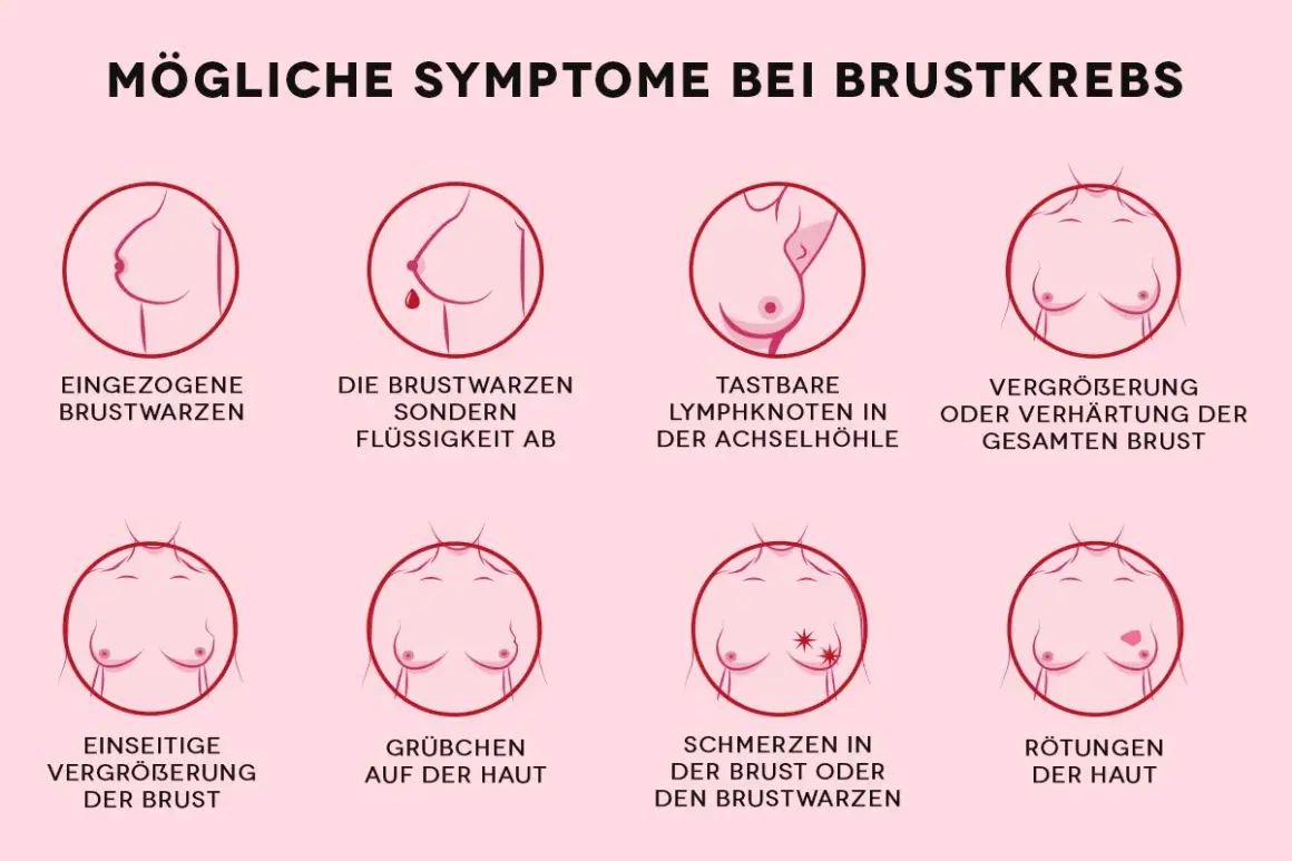 Grafik zeigt mögliche Symptome von Brustkrebs, darunter tastbare Lymphknoten in der Achselhöhle und eine Vergrößerung oder Verhärtung der Brust.