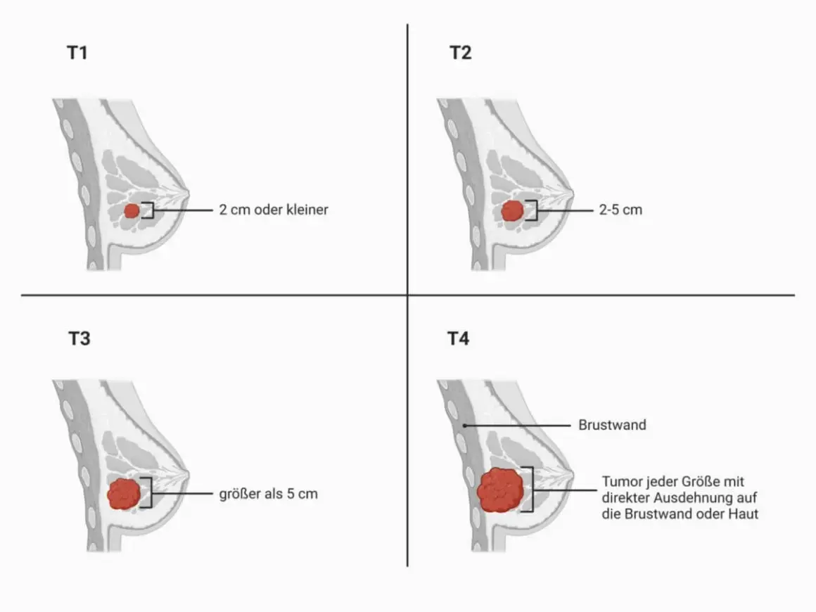 Veranschaulicht die **Mammakarzinom Stadien** T1 (kleiner als 2 cm), T2 (2-5 cm), T3 (größer als 5 cm) und T4 (Ausdehnung auf Brustwand/Haut).