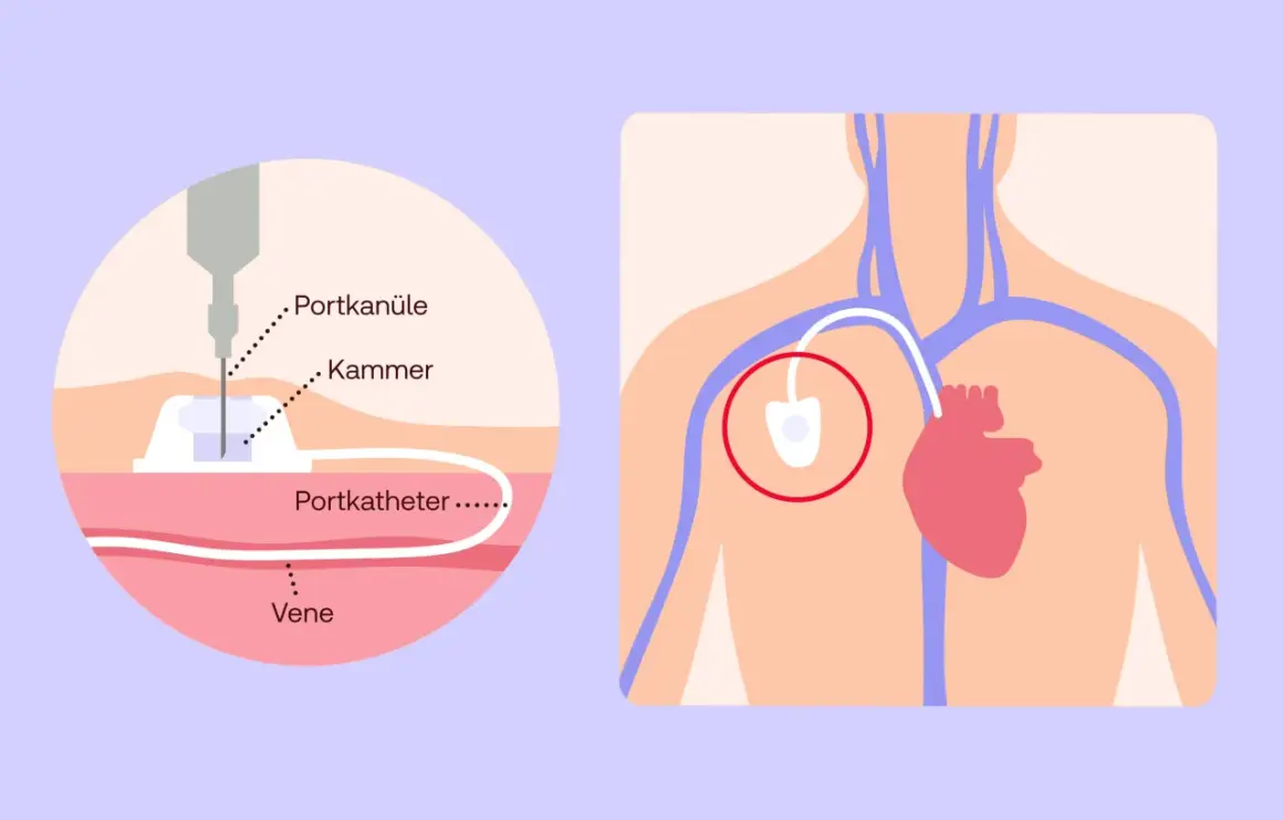 Schema zeigt ein medizinisches Portsystem: eine Nadel (Portkanüle) in der Kammer, verbunden mit einem Katheter in einer Vene. Das Port-System liegt nahe dem Herzen.