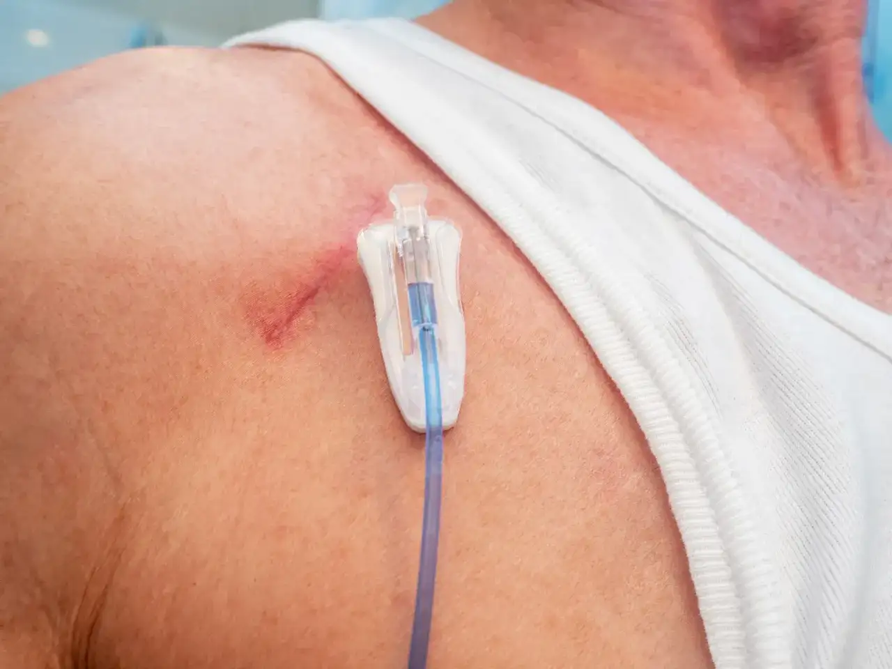 Chemoport-Bilder verstehen - Was zeigen Fotos wirklich?