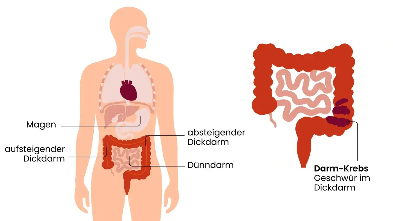 Darmkrebs Symptome - Was wirklich zählt & wann zum Arzt?