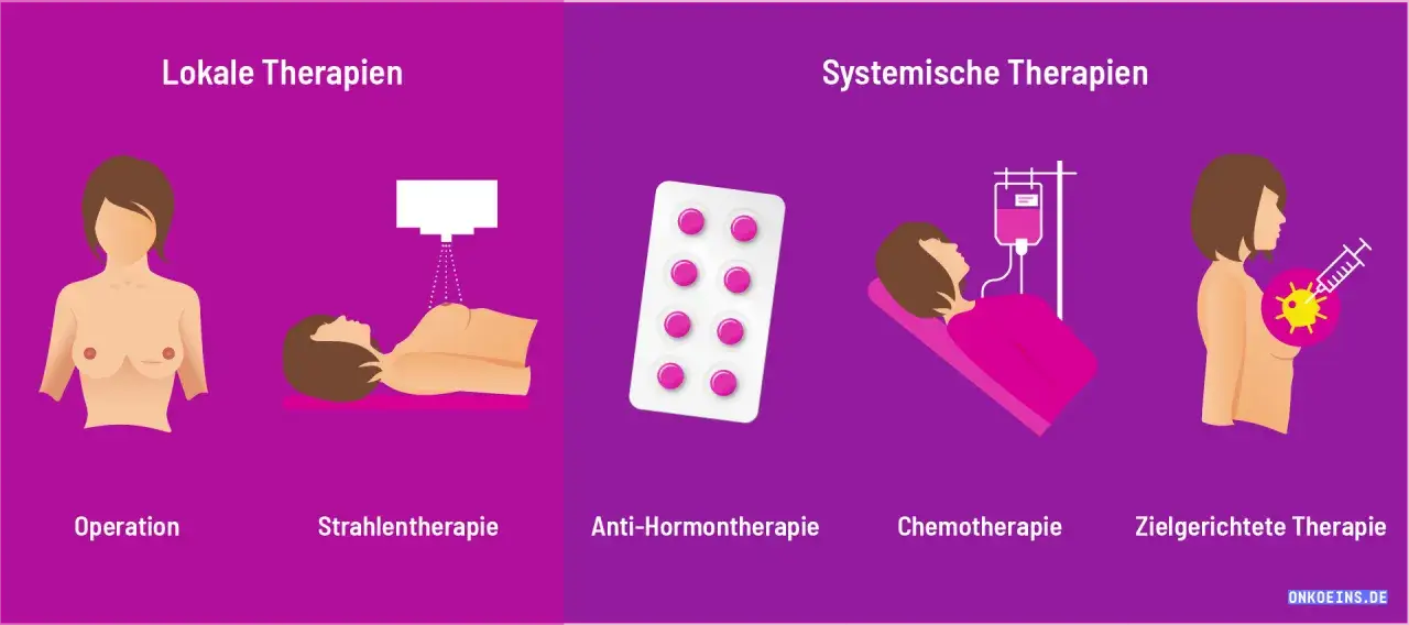 Illustration zeigt lokale und systemische Therapien bei Brustkrebs: Operation, Strahlentherapie, Anti-Hormontherapie, Chemotherapie, zielgerichtete Therapie.