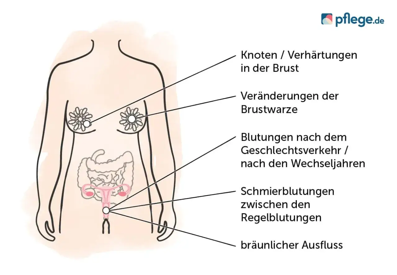 Körper mit Markierungen für mögliche Symptome, die auf einen Tumor hinweisen könnten: Knoten in der Brust, Veränderungen der Brustwarze, Blutungen, Ausfluss.