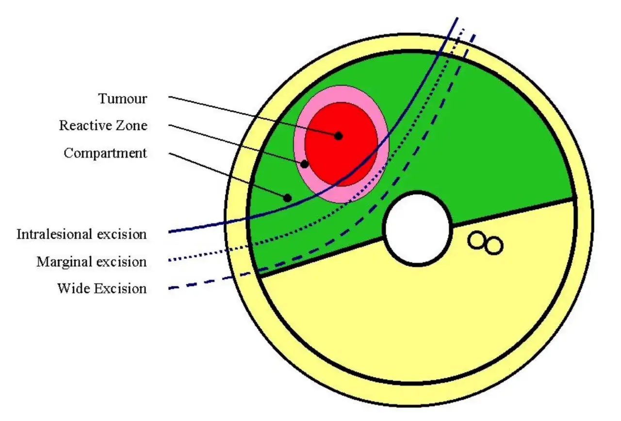 Schema zeigt Tumor, reaktive Zone und Kompartiment. Verschiedene Resektionsmethoden: intraläsional, marginal und r0 resektion (weit).
