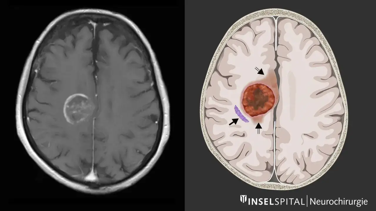 MRT-Aufnahme und schematische Darstellung eines gehirntumors echt. Der Tumor ist als rote Masse mit dunklem Zentrum erkennbar.