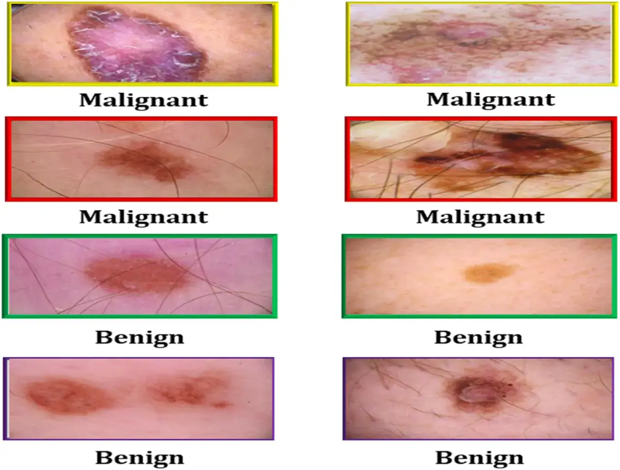 Vergleich von Hautveränderungen: Oben sind vier Beispiele für schwarzen Hautkrebs (maligne) und unten vier gutartige Muttermale (benigne) zu sehen.