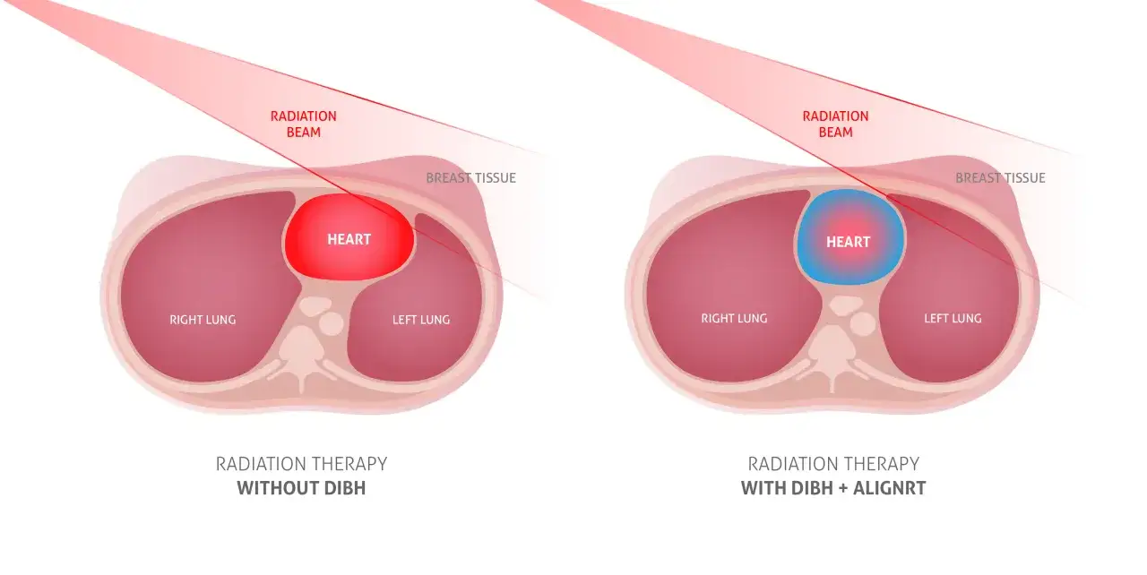 Vergleich zweier Strahlentherapien: Links trifft der Strahl das Herz, rechts schützt die atemgesteuerte Bestrahlung (DIBH) das Herz.