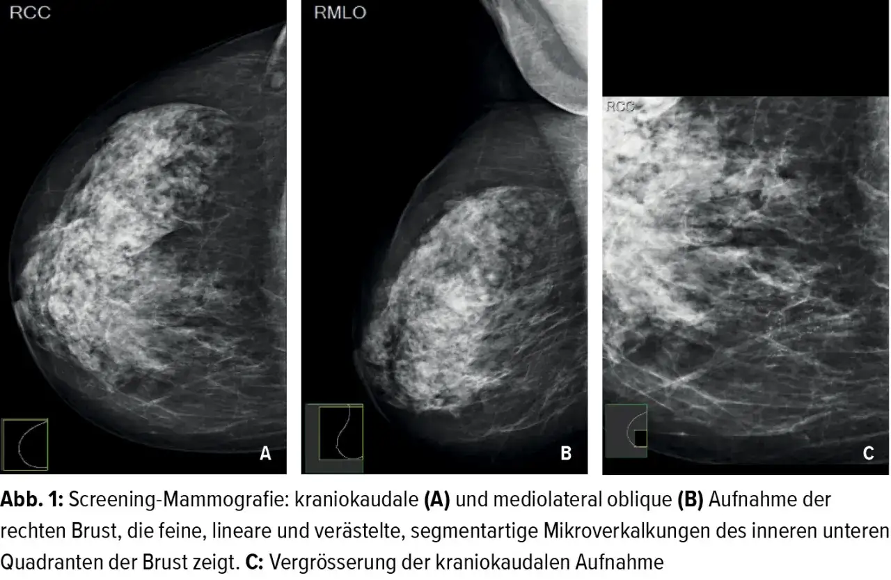 Mammografie-Aufnahmen zeigen feine, segmentartige Mikroverkalkungen in der Brust.