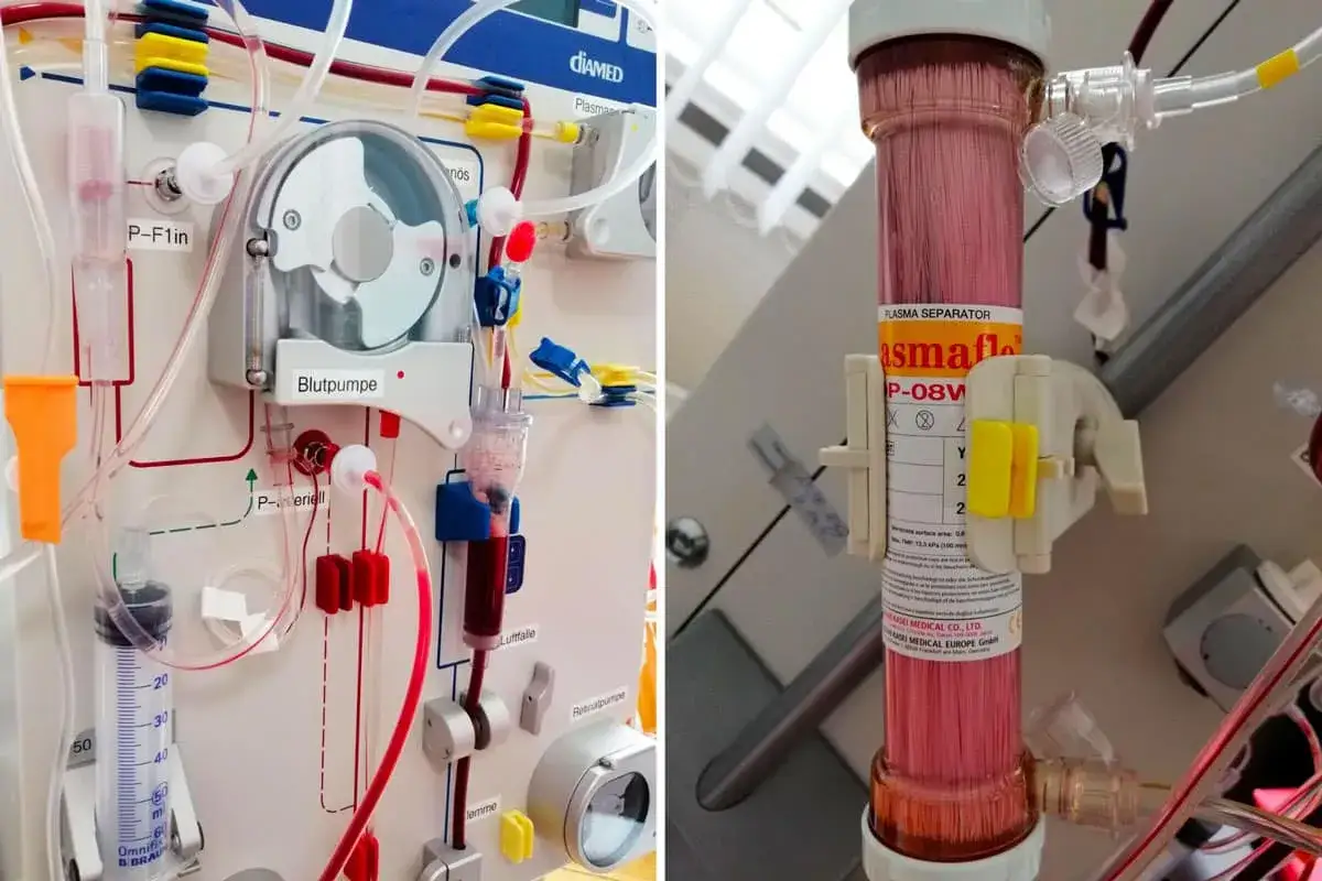 Nahaufnahme eines medizinischen Geräts, das den Leukapherese Ablauf zeigt. Blutpumpe und Plasma Separator sind sichtbar.