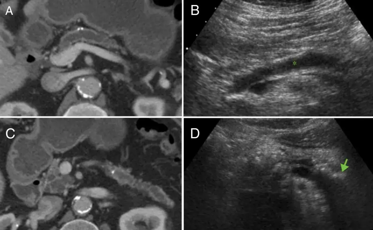 CT- und Ultraschallbilder zeigen eine Pankreas-Untersuchung. Bild B markiert mit Sternchen, Bild D mit Pfeil.