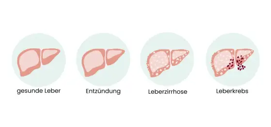 Leberkrebs Symptome - Wann Sie handeln müssen