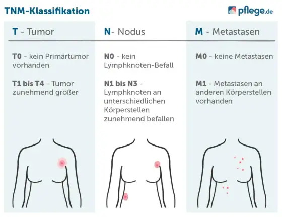 Maligne Tumoren verstehen - Arten, Diagnose & Behandlung