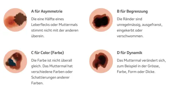 Schwarzer Hautkrebs-Früherkennung - So schützen Sie sich!