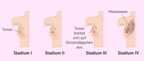 Brustkrebs Stadium III - Prognose, Therapie & Erfahrungen verstehen