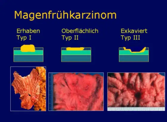 pT2 Befund - Was er wirklich bedeutet & Ihre Prognose