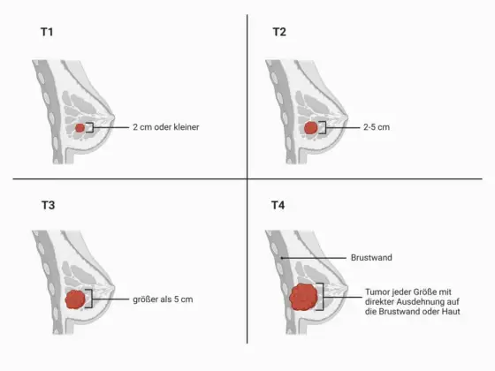 Mammakarzinom-Stadien: TNM & Biologie verstehen