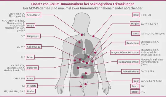 CEA-Werte richtig deuten - Was Ihr Tumormarker wirklich sagt